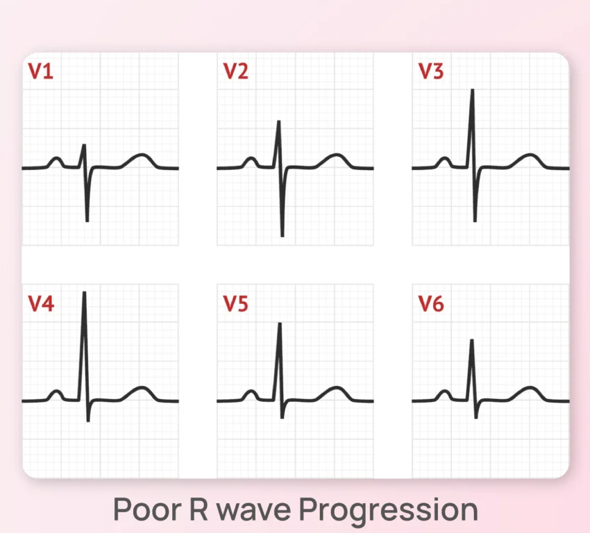 AI-Assisted ECG Analysis