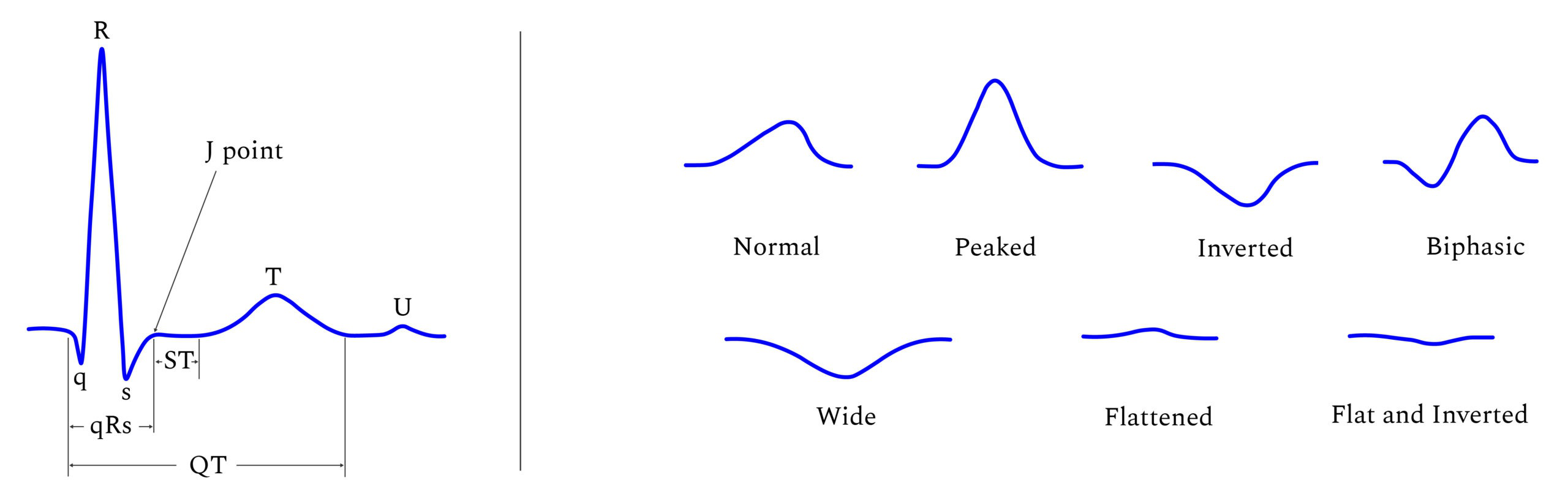St Interval Normal Range AI-Assisted ECG Analysis